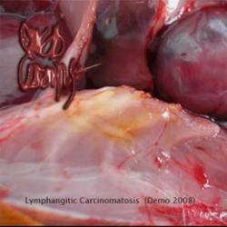 Lymphangitic Carcinomatosis